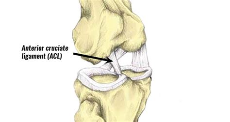 Anterior cruciate ligament (ACL) treatment.
